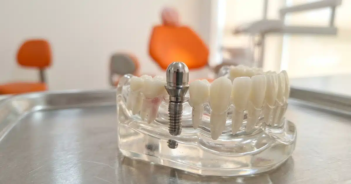 Componentes de um implante dentário: pino no osso, cicatrizador, pilar e coroa, explicados na DENT+ Niterói e São Gonçalo