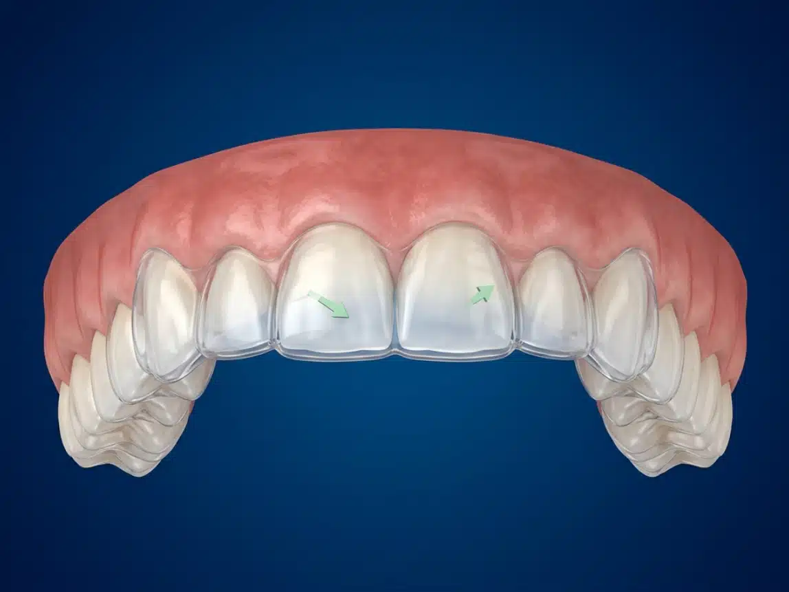 Ilustração da movimentação dentária causada pelo alinhador invisível