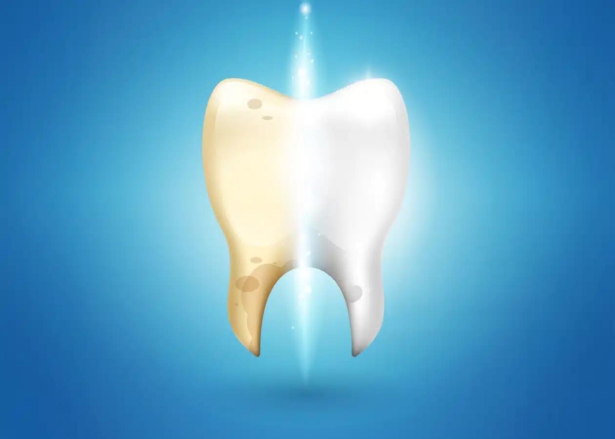 Ilustração de dente mostrando metade amarelada antes do clareamento e metade branca após a ação do peróxido