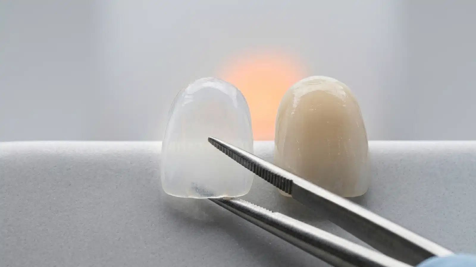 Lâmina ultrafina de lente de contato dental ao lado de faceta de porcelana mais espessa