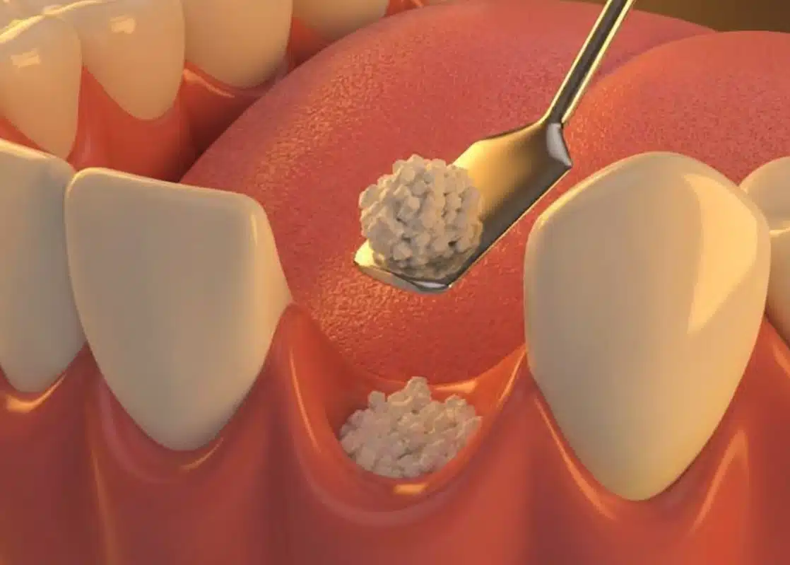 Ilustração 3D mostrando aplicação de partículas de enxerto ósseo na gengiva — procedimento pré-implante feito na DENT+ Niterói