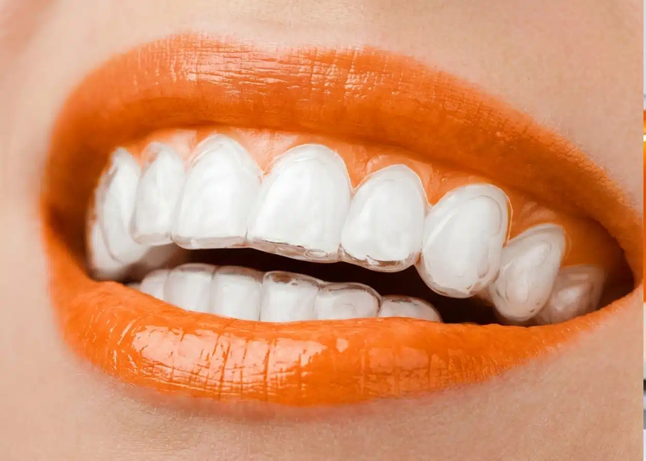 Placa transparente do alinhador invisível em detalhe — tratamento ortodôntico digital da DENT+ em Niterói e São Gonçalo