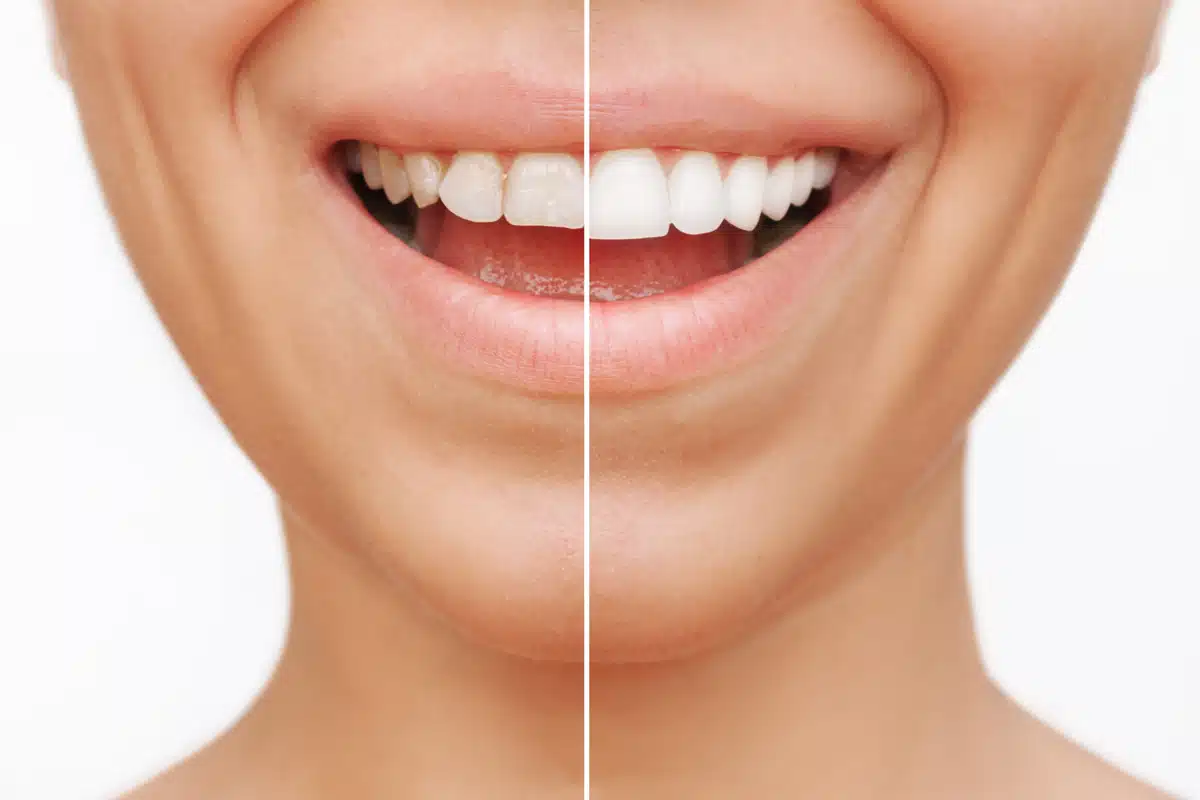 Comparativo antes e depois mostrando dentes mais brancos e uniformes após lente de contato dental na DENT+ Niterói
