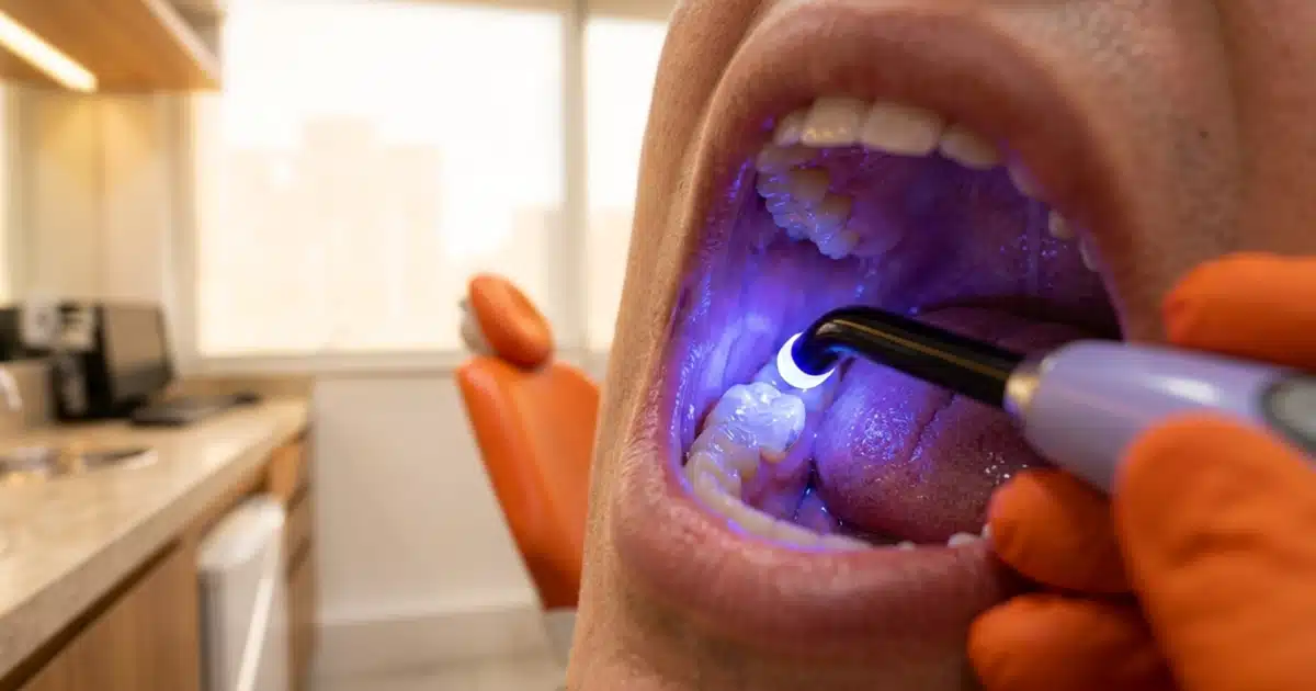 Restauração dentária em resina com fotopolimerização na DENT+
